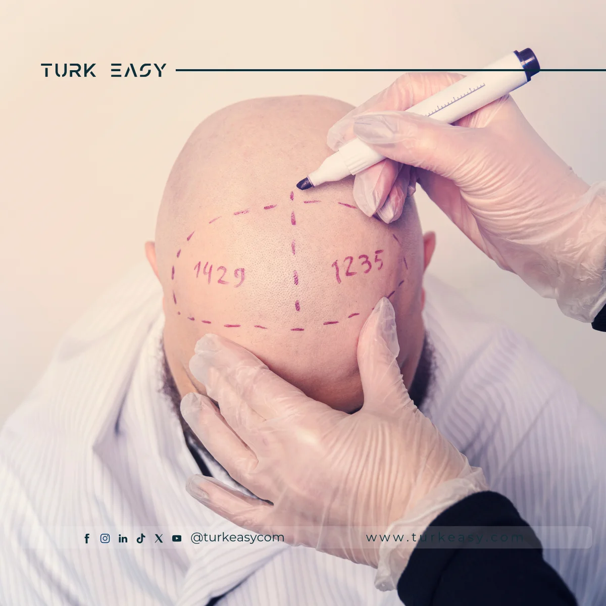 Пересадка волосся 2024 | Turk Easy