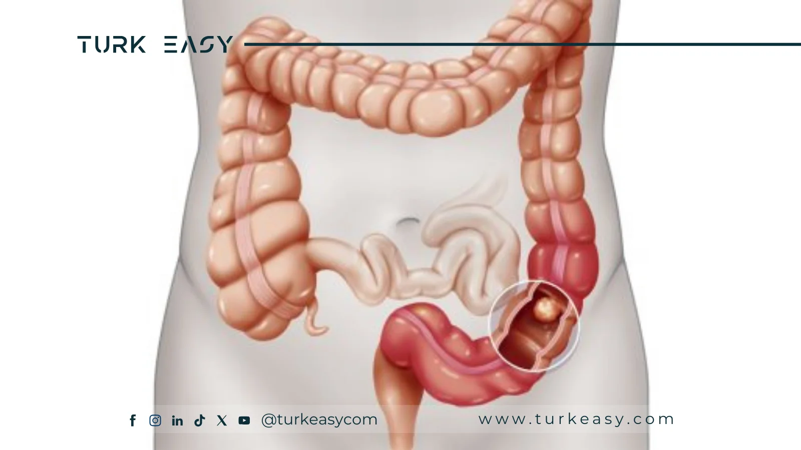 Abdominal Jejunal Resection 2024 |  Turk Easy 