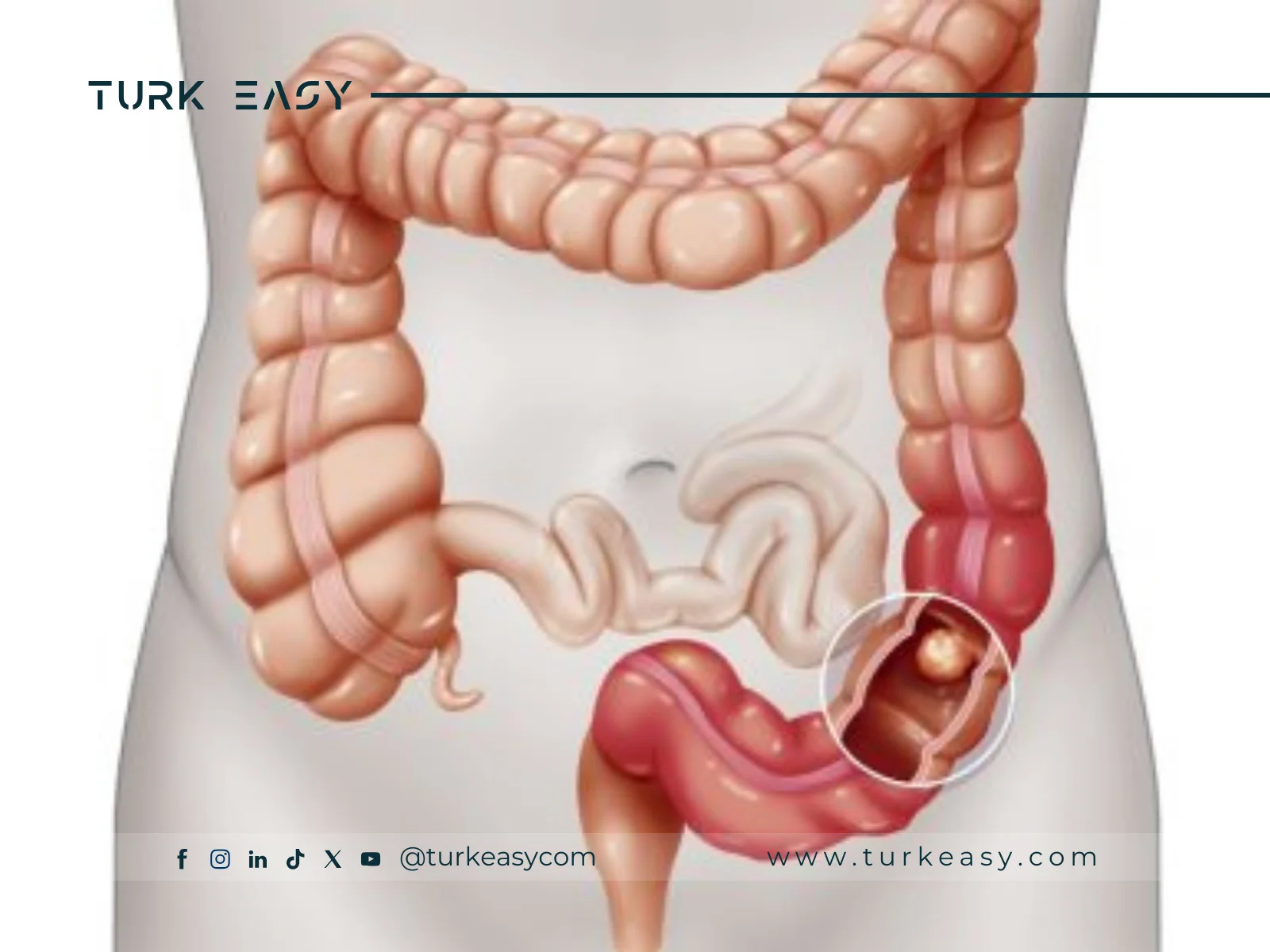 Abdominal Jejunal Resection 2024 |  Turk Easy 