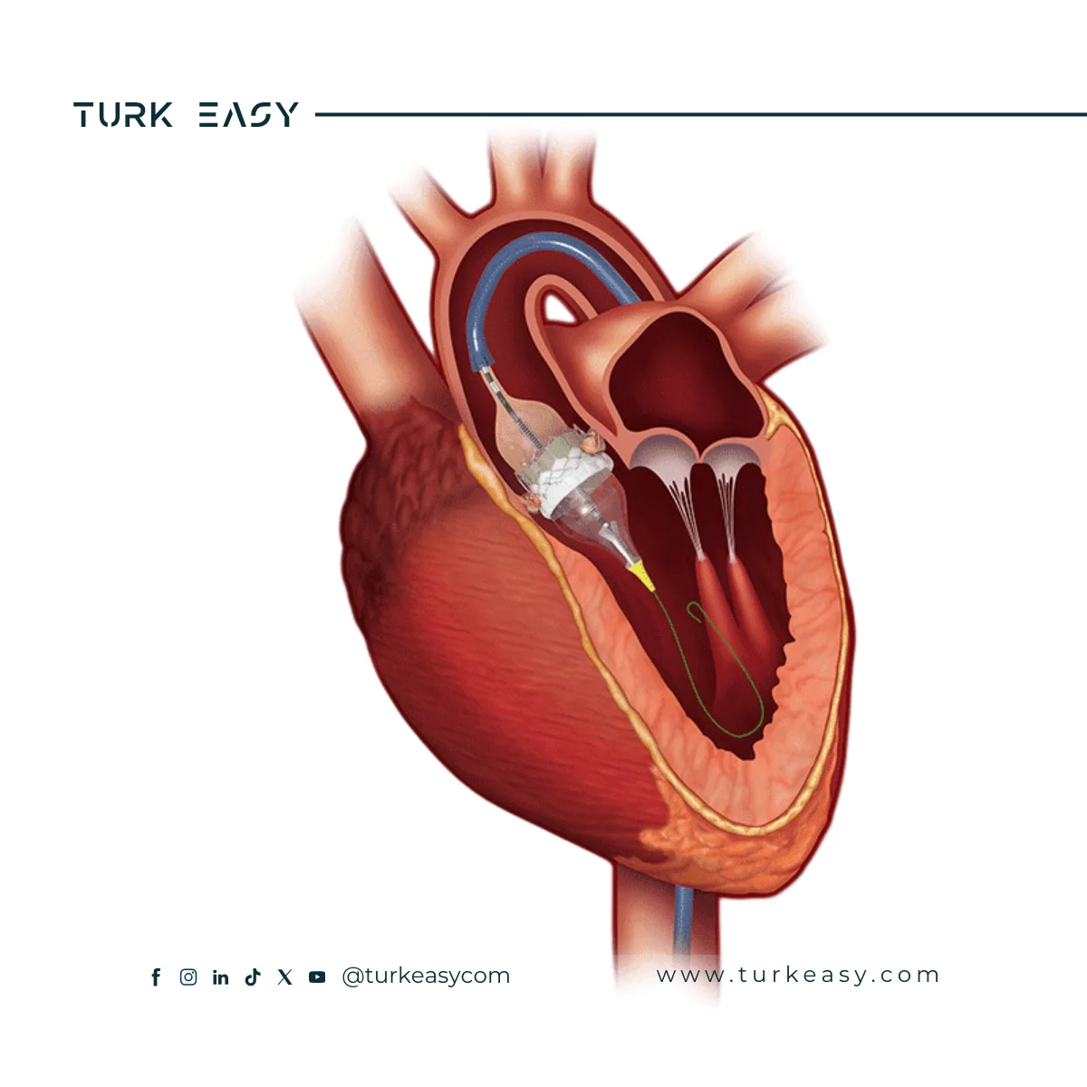 Remplacement de la valve aortique 2024 | Turk Easy