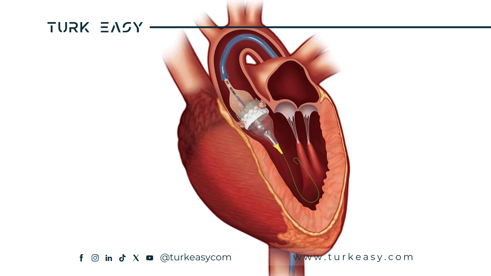 Заміна аортального клапана 2024 | Turk Easy