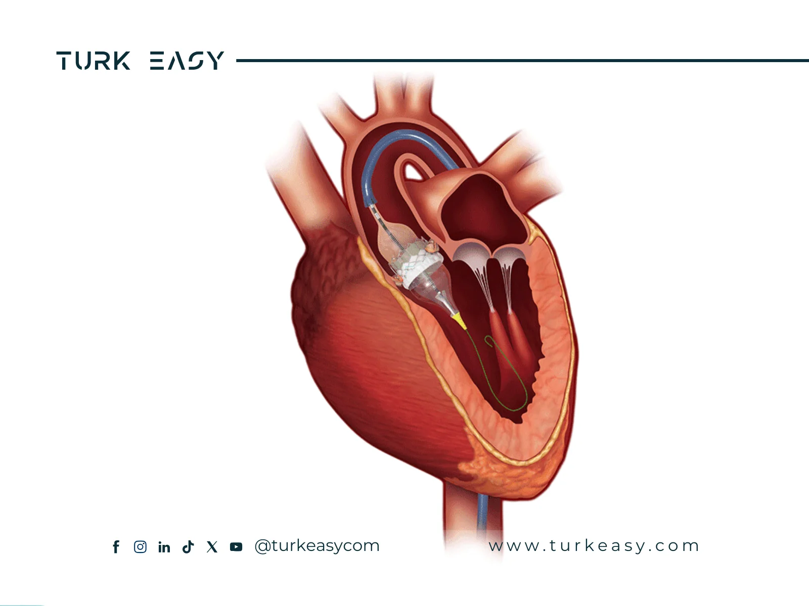 Remplacement de la valve aortique 2024 | Turk Easy
