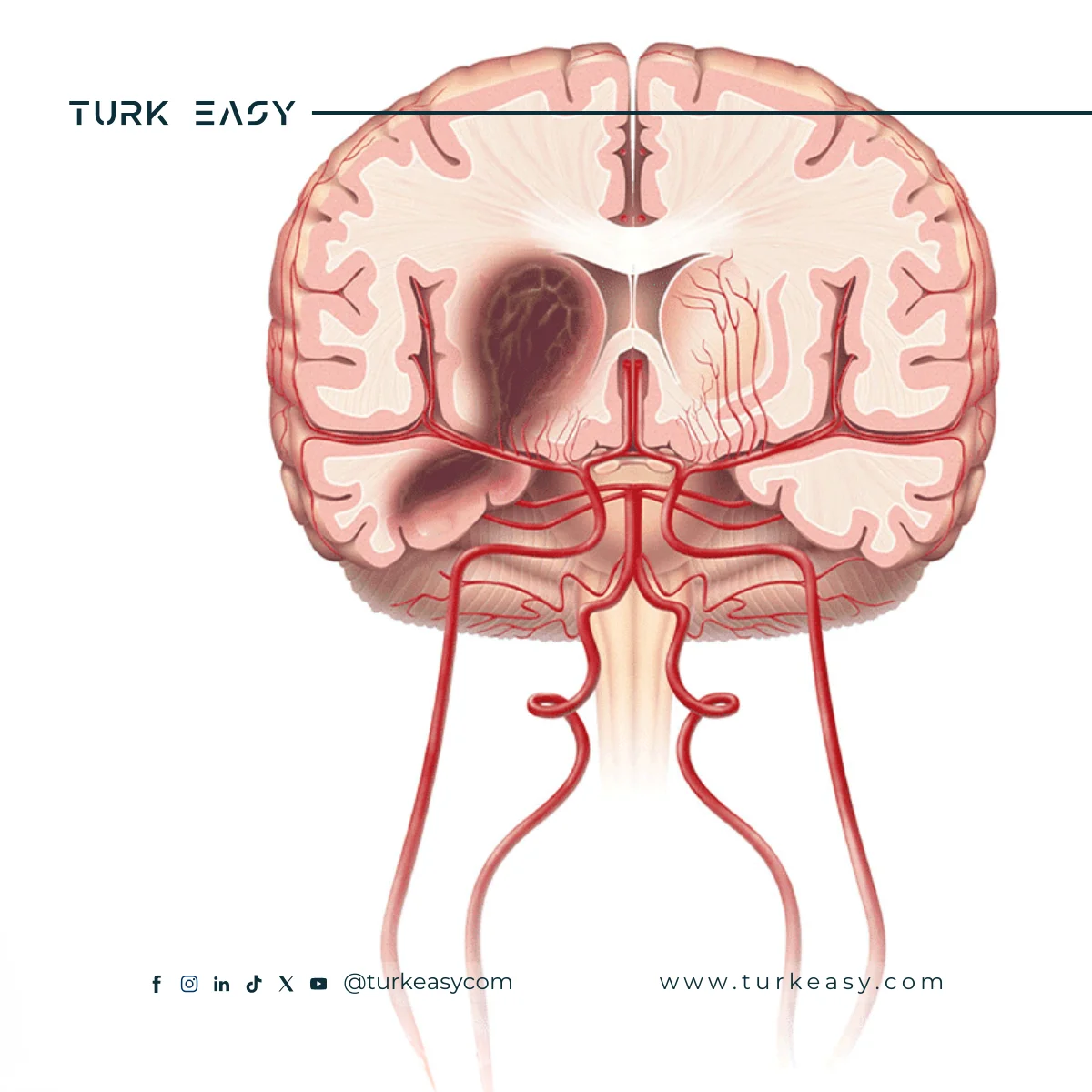 Хірургія геморагічного ураження в мозку 2024 | Turk Easy