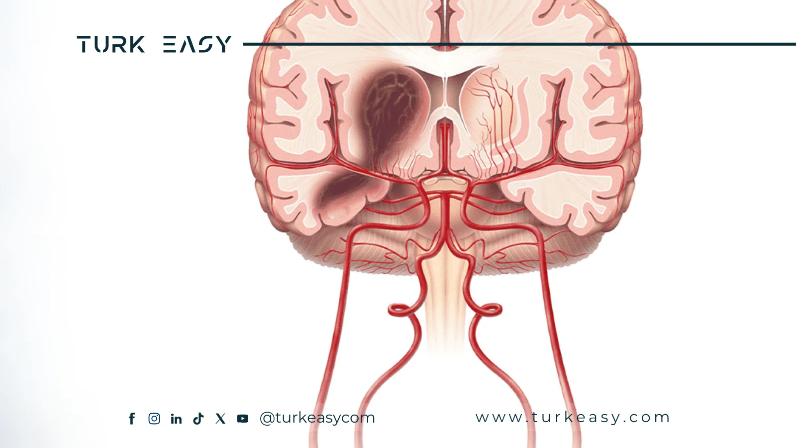 Chirurgie de lhémorragie cérébrale 2024 | Turk Easy