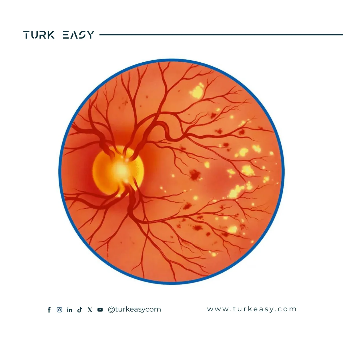 Chirurgie de la rétinopathie diabétique 2024 | Turk Easy
