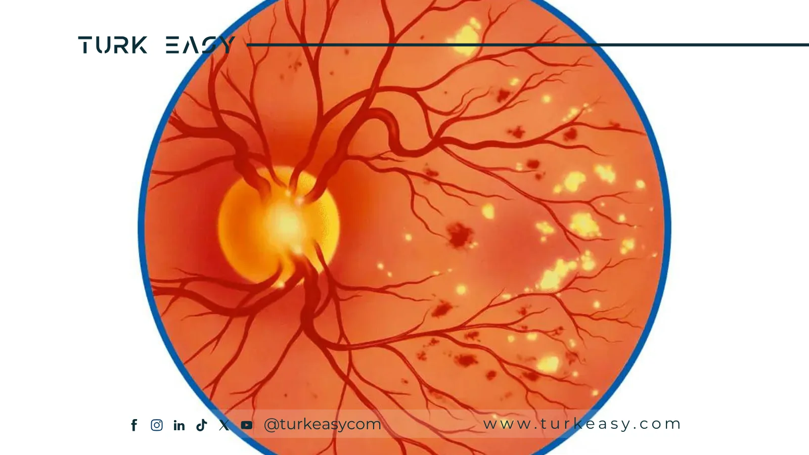 Хірургія діабетичної ретинопатії