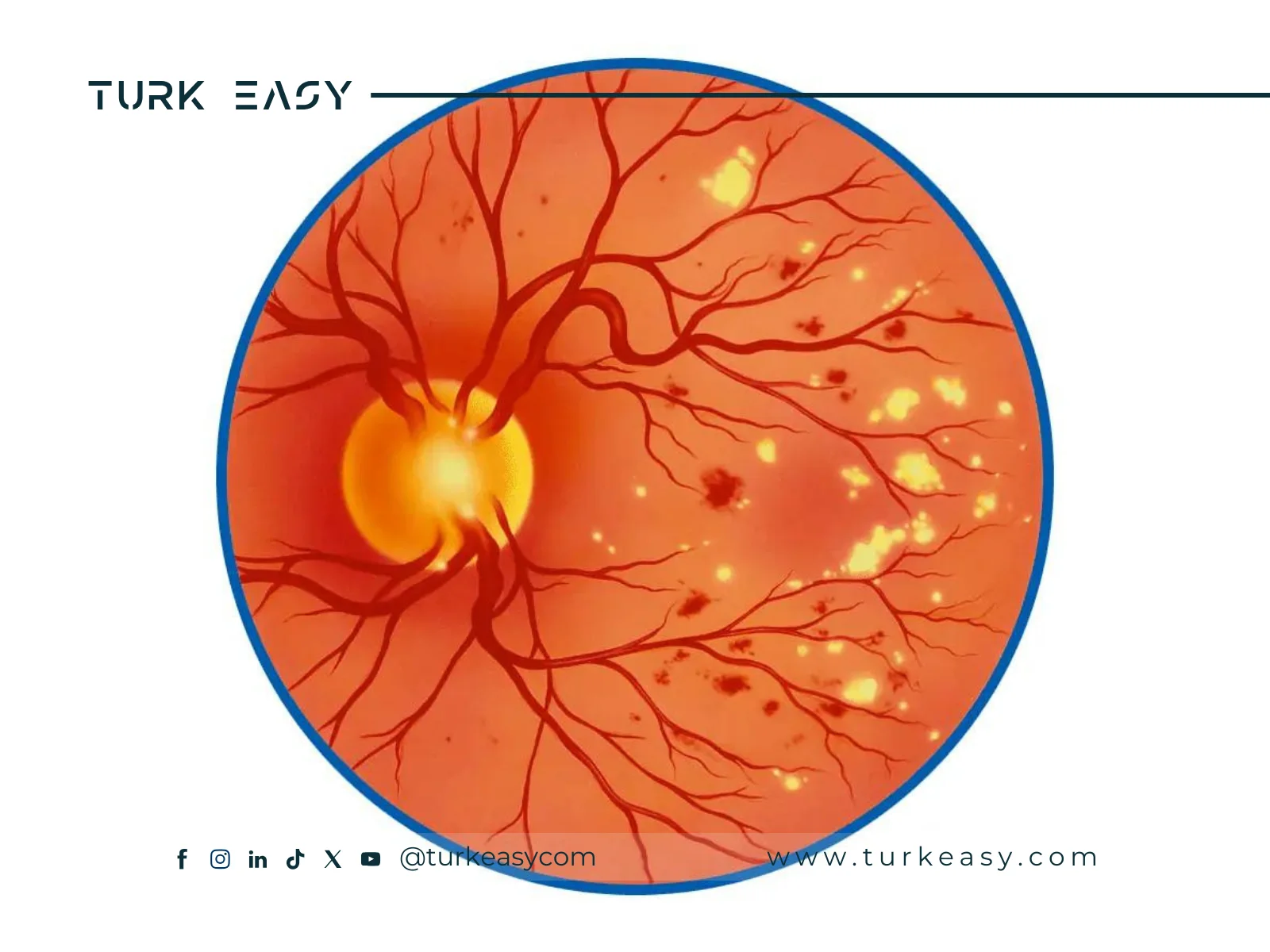 Хирургия диабетической ретинопатии 2024 | Turk Easy