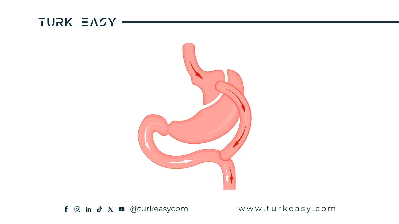 Bypass gastrique 2024 | Turk Easy