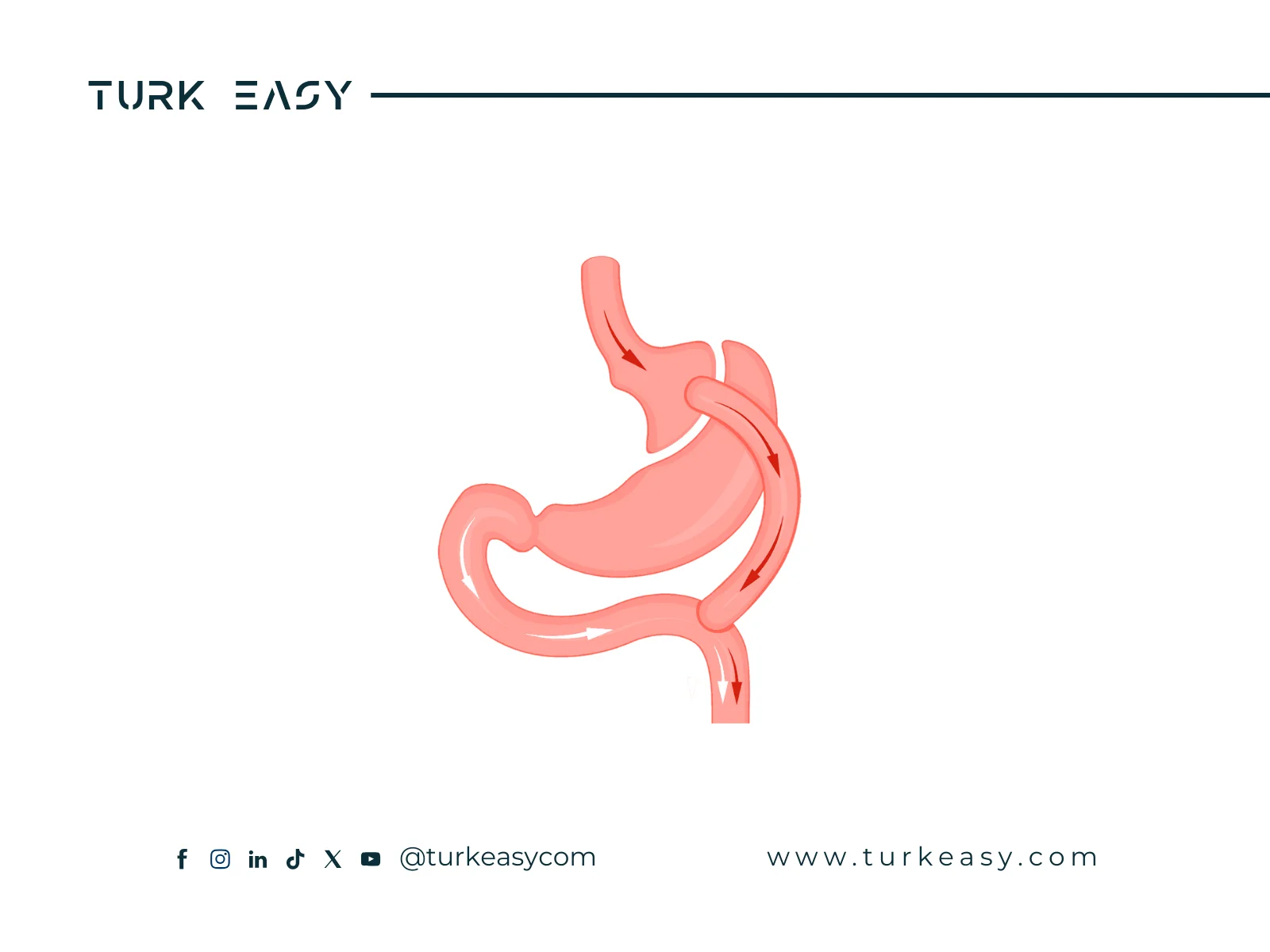 Желудочное шунтирование 2024 | Turk Easy