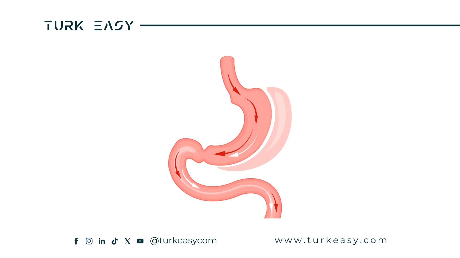 Операция по удалению части желудка 2024 | Turk Easy