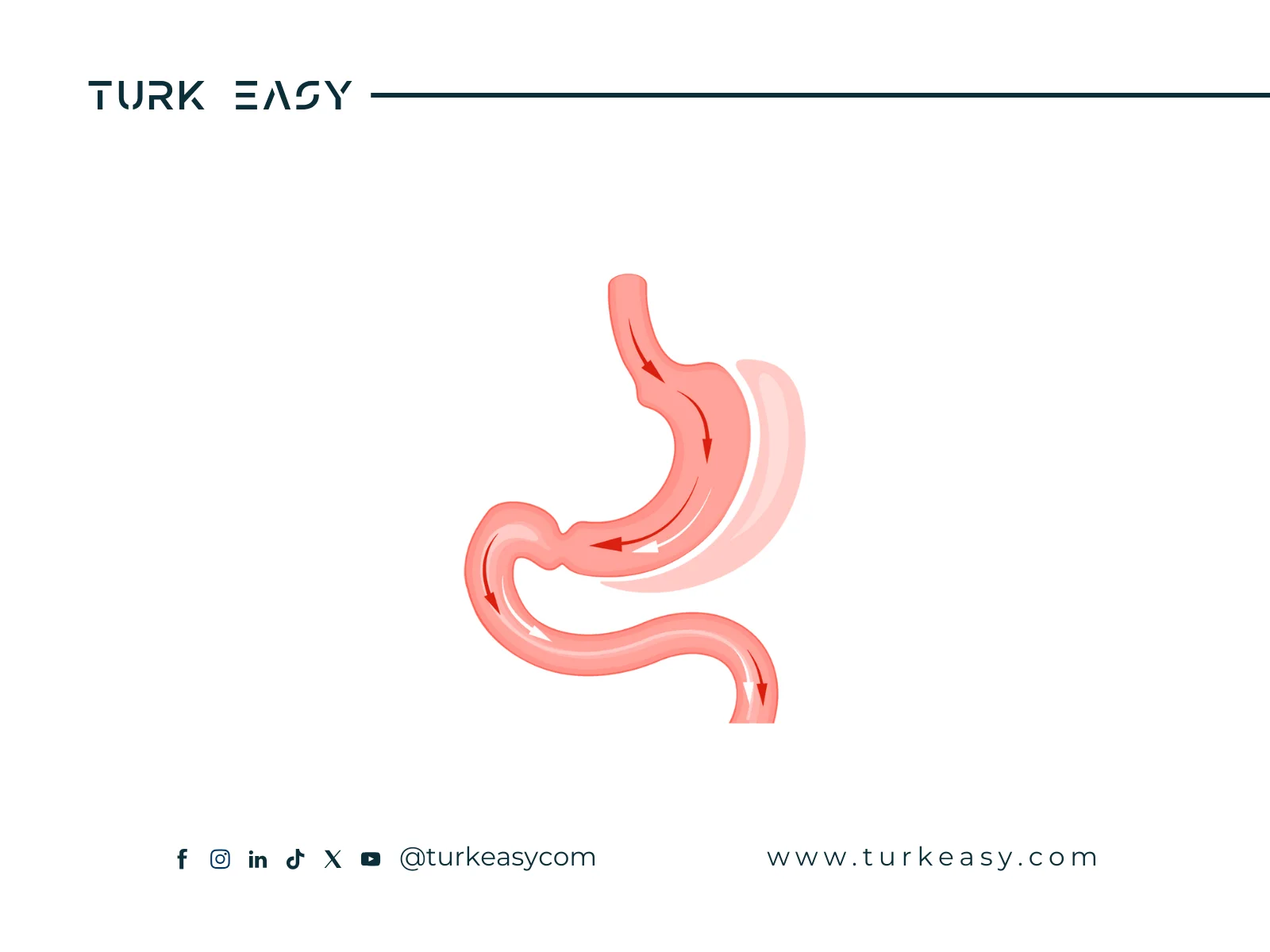 Операция по удалению части желудка 2024 | Turk Easy