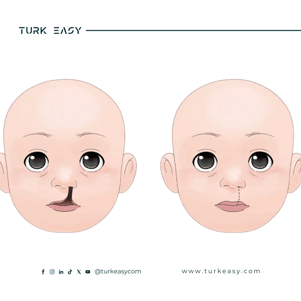 Разрез губы 2024 |  Turk Easy 