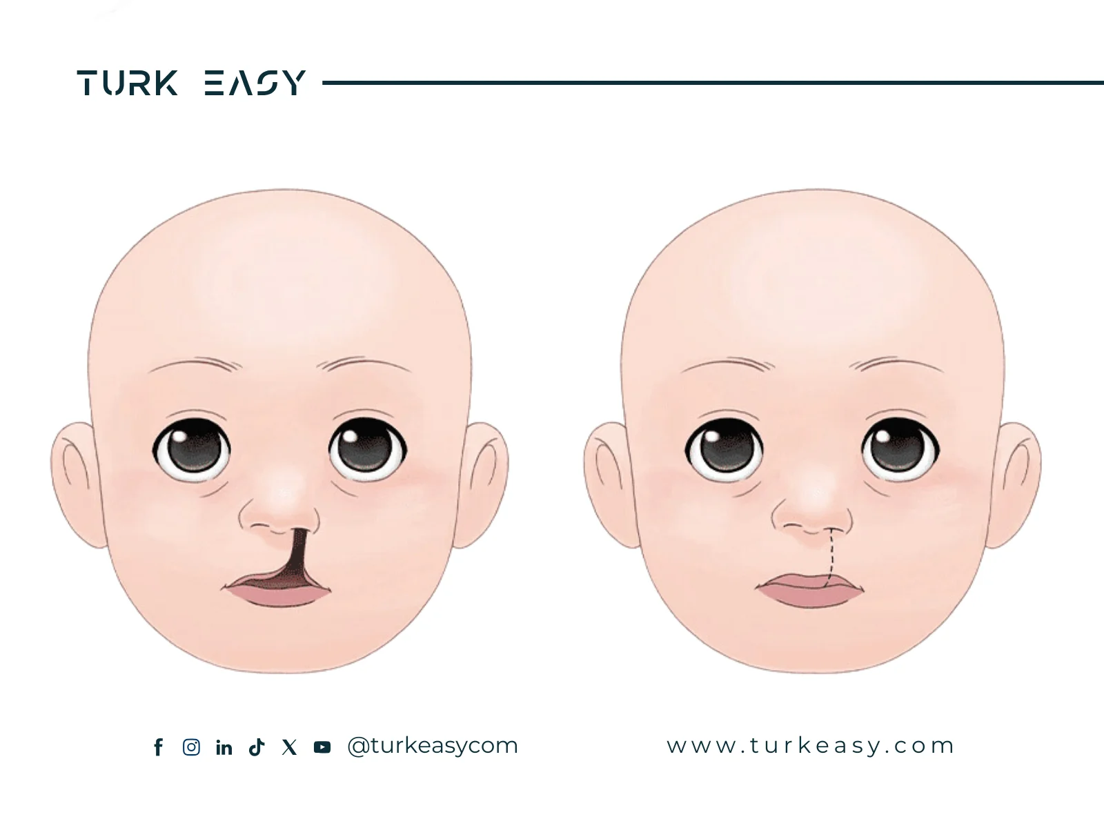 Разрез губы 2024 |  Turk Easy 