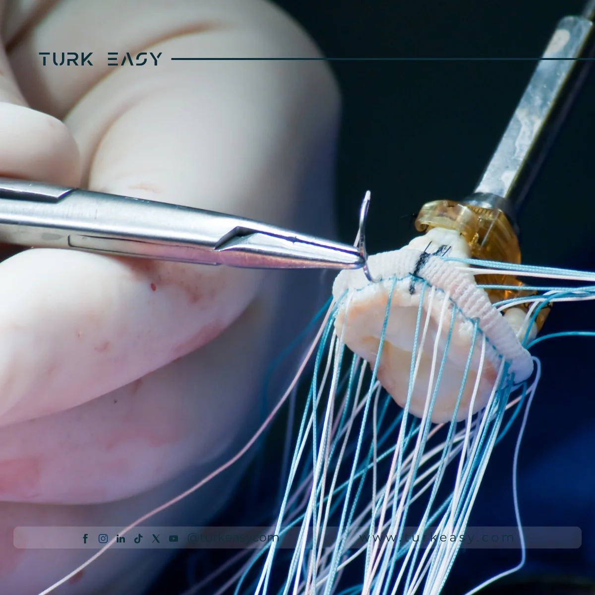 Heart Valve Replacement 2024 | Turk Easy