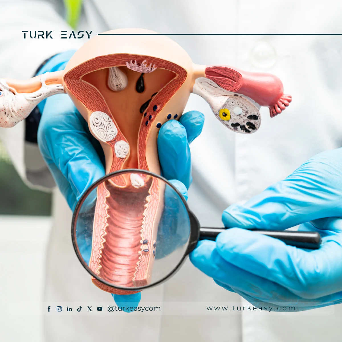 Ligature tubaire laparoscopique 2024 | Turk Easy