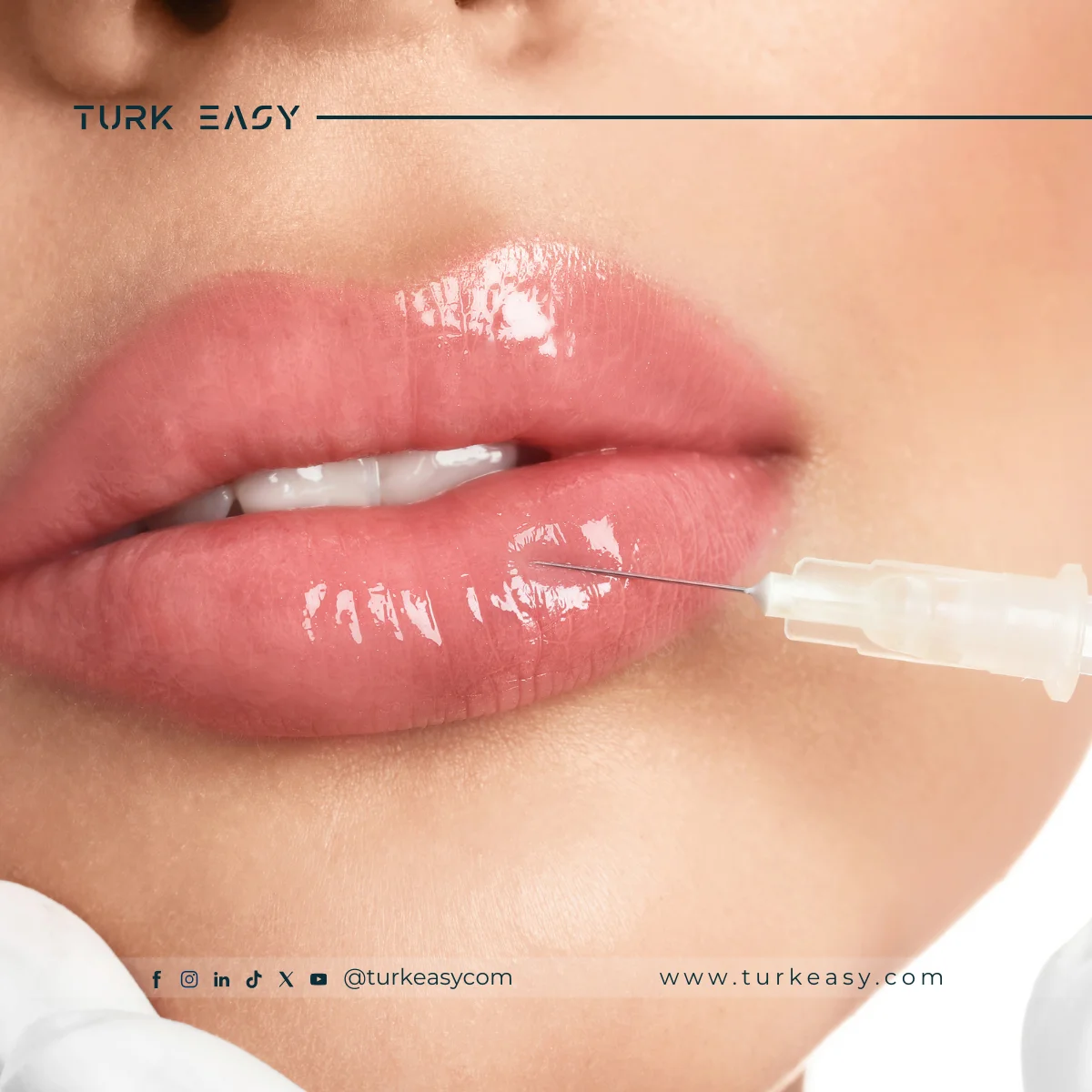 Увеличение губ: Процедура, Причины и Типы