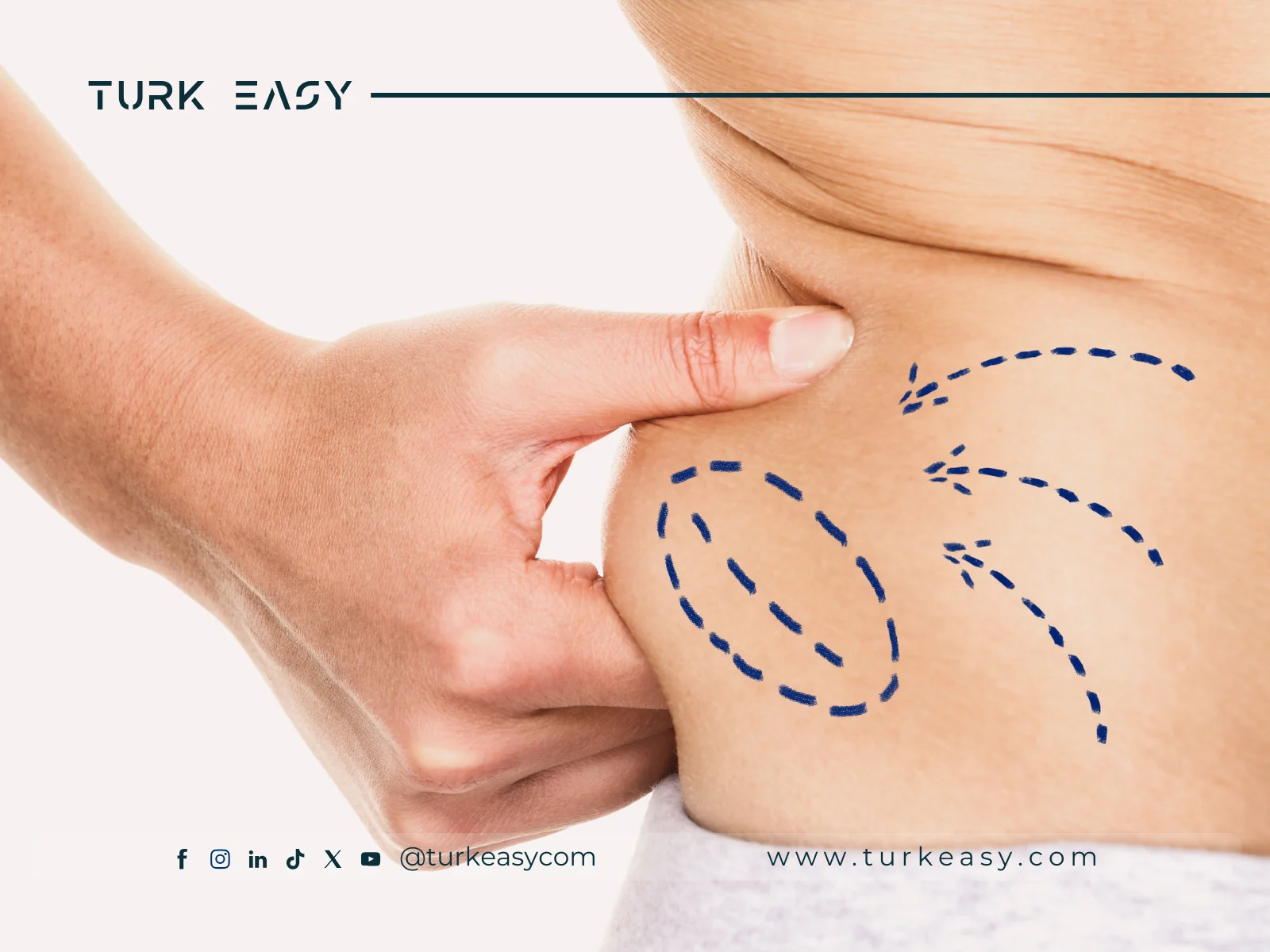 Liposuction 2024 | Turk Easy