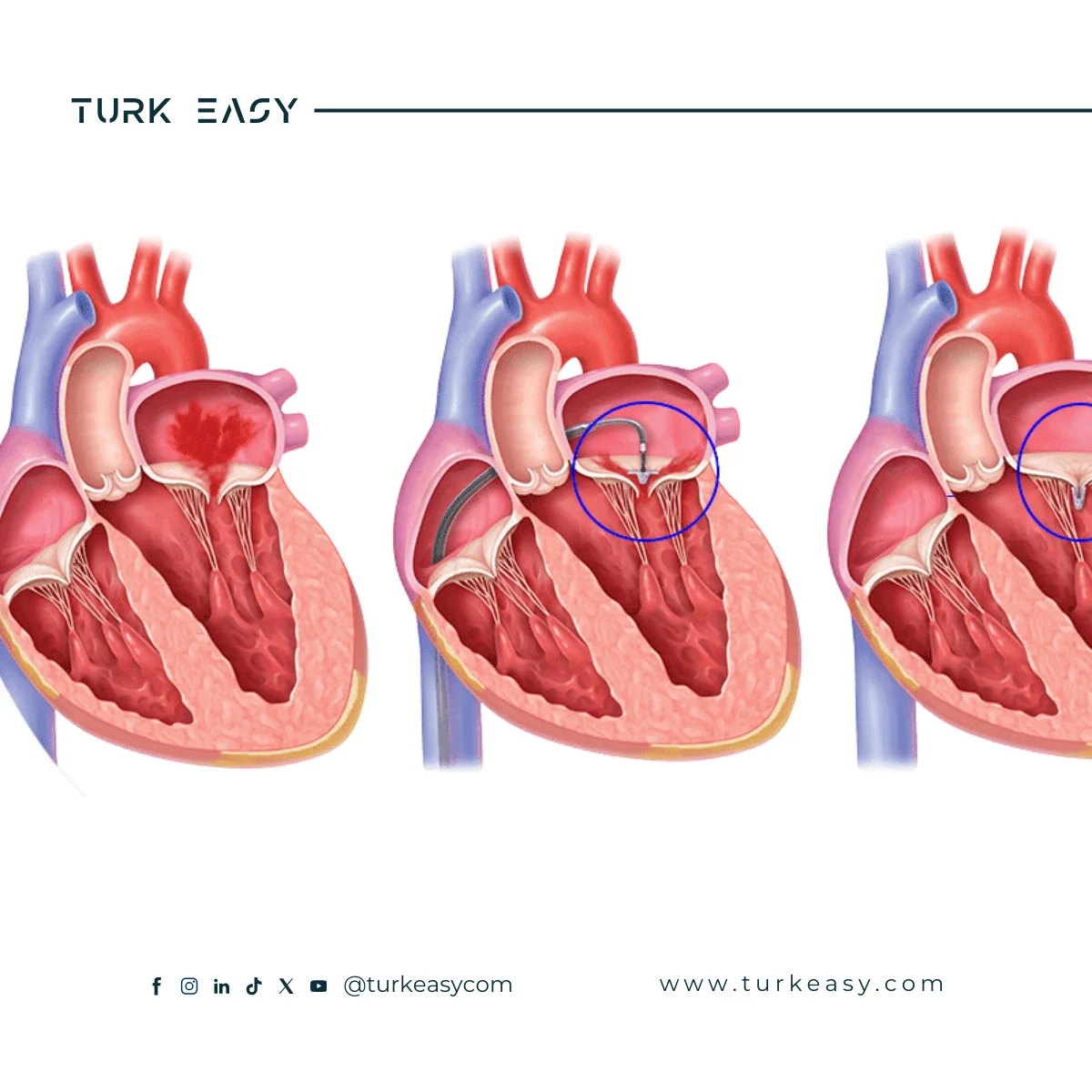 Mitral Valve Replacement 2024 | Turk Easy