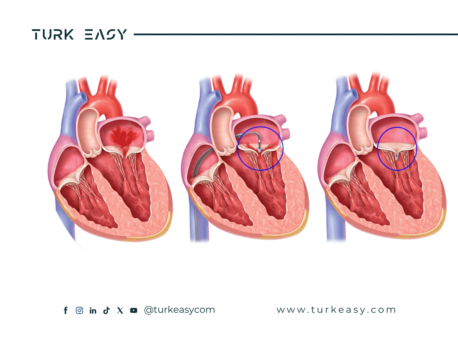 Mitral Valve Replacement 2024 | Turk Easy