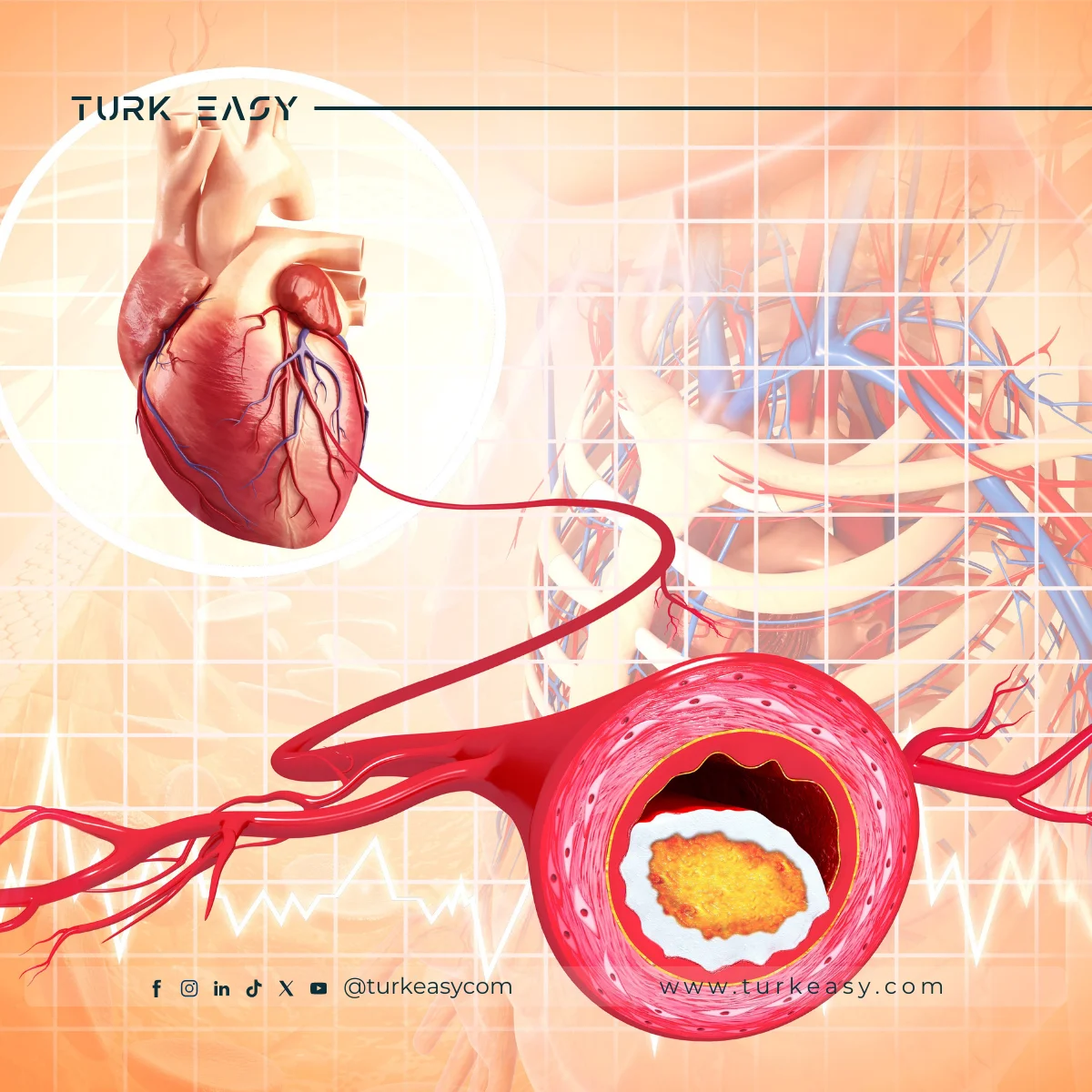 Transposition des grandes artères 2024 | Turk Easy
